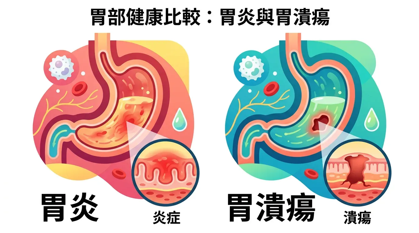 全面盤點：症狀辨識：是胃炎還是潰瘍？